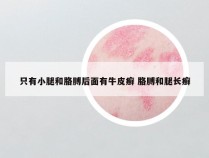 只有小腿和胳膊后面有牛皮癣 胳膊和腿长癣