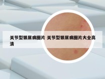 关节型银屑病图片 关节型银屑病图片大全高清