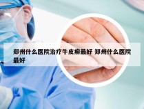 郑州什么医院治疗牛皮癣最好 郑州什么医院最好