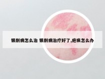 银削病怎么治 银削病治疗好了,疤痕怎么办