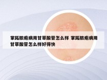 掌跖脓疱病用甘草酸苷怎么样 掌跖脓疱病用甘草酸苷怎么样好得快