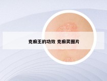 克癣王的功效 克癣灵图片