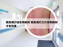 银屑病打啥生物制剂 银屑病打几针生物制剂才有效果