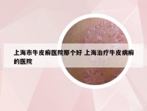 上海市牛皮癣医院那个好 上海治疗牛皮病癣的医院