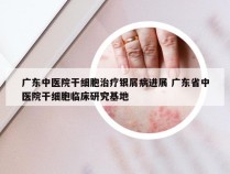 广东中医院干细胞治疗银屑病进展 广东省中医院干细胞临床研究基地