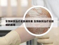 生物制剂治疗皮肤病效果 生物制剂治疗皮肤病的原理