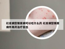 红皮病型银屑病可以吃什么药 红皮病型银屑病外用药治疗首选