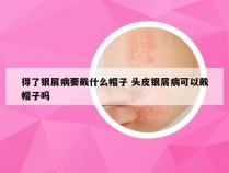 得了银屑病要戴什么帽子 头皮银屑病可以戴帽子吗