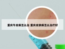 重庆牛皮癣怎么治 重庆皮肤癣怎么治疗好