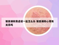 银屑病和焦虑症一起怎么办 银屑病和心理有关系吗