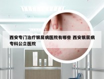 西安专门治疗银屑病医院有哪些 西安银屑病专科公立医院