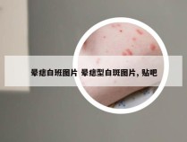 晕痣白班图片 晕痣型白斑图片, 贴吧