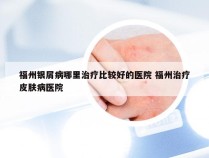 福州银屑病哪里治疗比较好的医院 福州治疗皮肤病医院