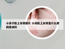 小孩子脸上白斑图片 小孩脸上白斑是什么原因造成的