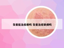 生姜能治皮癣吗 生姜治皮肤病吗