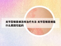 关节型银屑病怎样治疗方法 关节型银屑病是什么原因引起的