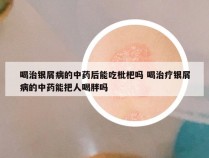 喝治银屑病的中药后能吃枇杷吗 喝治疗银屑病的中药能把人喝胖吗