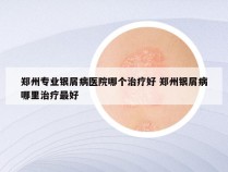 郑州专业银屑病医院哪个治疗好 郑州银屑病哪里治疗最好