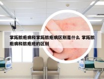 掌跖脓疱病和掌跖脓疱病区别是什么 掌跖脓疱病和脓疱疮的区别