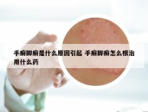 手癣脚癣是什么原因引起 手癣脚癣怎么根治用什么药