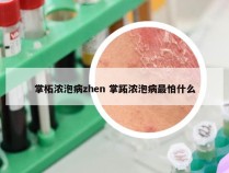 掌柘浓泡病zhen 掌跖浓泡病最怕什么