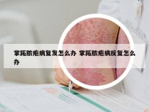 掌跖脓疱病复发怎么办 掌跖脓疱病反复怎么办