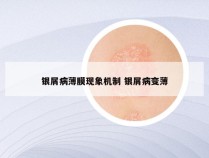 银屑病薄膜现象机制 银屑病变薄