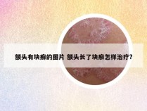 额头有块癣的图片 额头长了块癣怎样治疗?