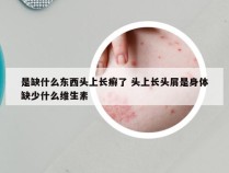 是缺什么东西头上长癣了 头上长头屑是身体缺少什么维生素