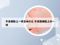 牛皮癣脸上一块玉米什么 牛皮肤癣脸上长一块