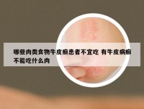 哪些肉类食物牛皮癣患者不宜吃 有牛皮病癣不能吃什么肉