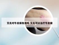 艾灸对牛皮癣有用吗 艾灸可以治疗牛皮廨