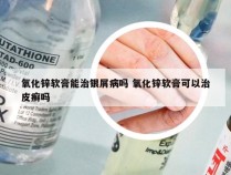 氧化锌软膏能治银屑病吗 氧化锌软膏可以治皮癣吗