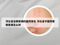 河北省治银屑病的医院排名 河北省中医院看银屑病怎么样