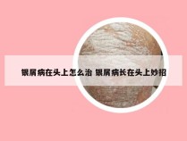 银屑病在头上怎么治 银屑病长在头上妙招