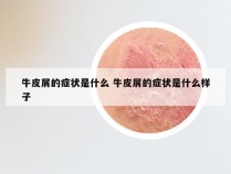 牛皮屑的症状是什么 牛皮屑的症状是什么样子