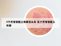 5个月宝宝腿上有癣怎么办 五个月宝宝腿上长癣