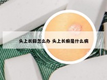 头上长藓怎么办 头上长癣是什么病