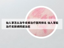 仙人掌怎么治牛皮癣治疗医院排名 仙人掌能治疗皮肤病彻底治愈