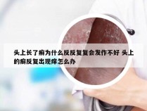 头上长了癣为什么反反复复会发作不好 头上的癣反复出现痒怎么办