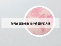 如何自己治疗癣 治疗癣最好的方法