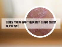 衡阳治疗银屑病哪个医院最好 衡阳看皮肤去哪个医院好