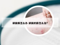 顽固癣怎么办 顽固的藓怎么治?