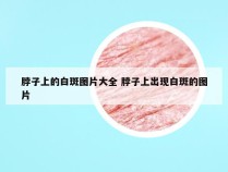 脖子上的白斑图片大全 脖子上出现白斑的图片