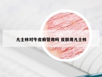 凡士林对牛皮癣管用吗 皮肤用凡士林