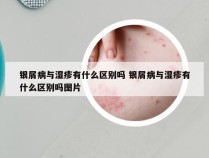 银屑病与湿疹有什么区别吗 银屑病与湿疹有什么区别吗图片