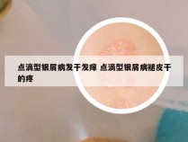 点滴型银屑病发干发痒 点滴型银屑病褪皮干的疼