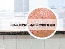 uvb治牛皮癣 uvb灯治疗银屑病周期