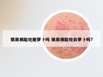 银屑病能吃脆萝卜吗 银屑病能吃白萝卜吗?