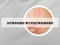 治疗银肖的医院 那个药治疗银肖病效果好